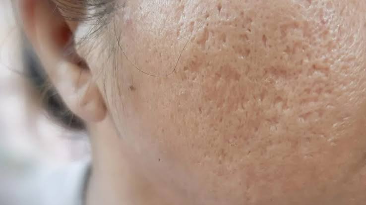boxcar acne scars treatment islamabad