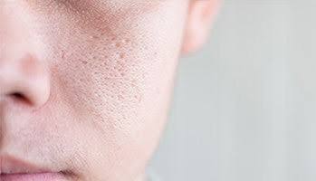 ice pick acne scars treatment islamabad